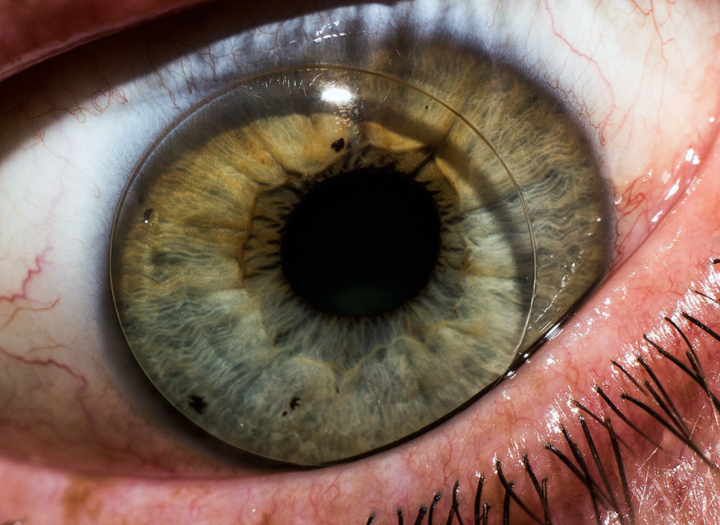 العدسات اللاصقة